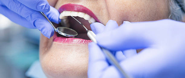 Best Knocked-Out Tooth (Avulsed Tooth) Treatment in Deshler, OH